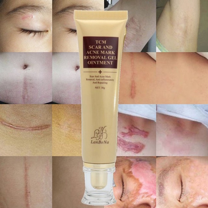 TCM Scar and Mark Removal Gel Landena Acne Cream 30g at 990.00 from